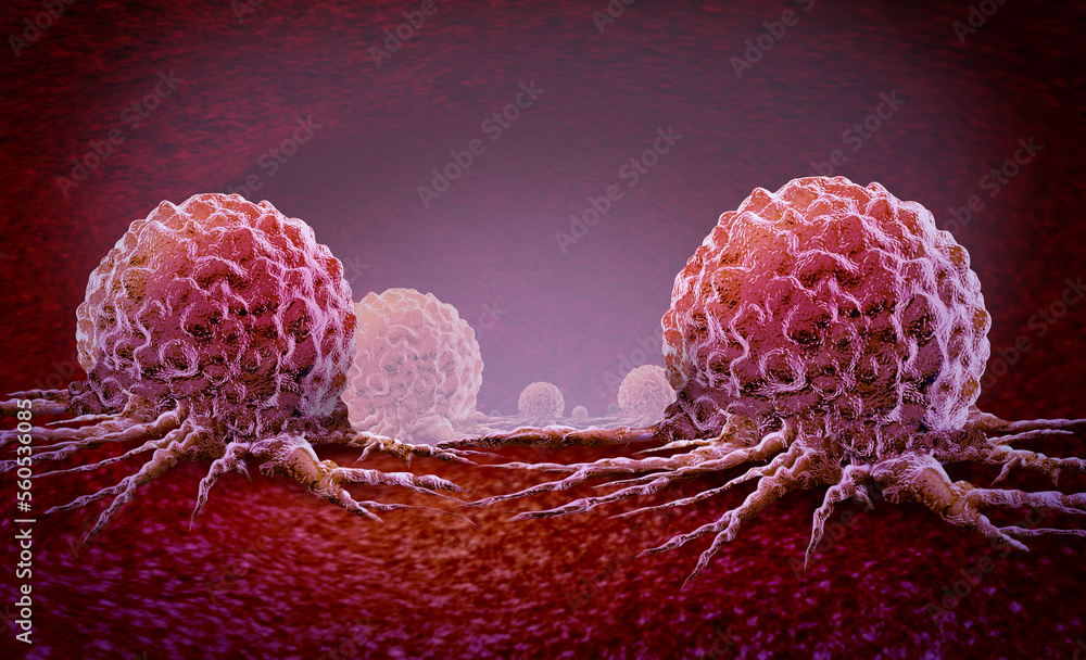 Cancer oncology and Malignant Cancerous Growth and Metastasis anatomy concept as growing tumor cells and Malignancy disease spreading metastasized on an organ inside the body - obrazy, fototapety, plakaty 