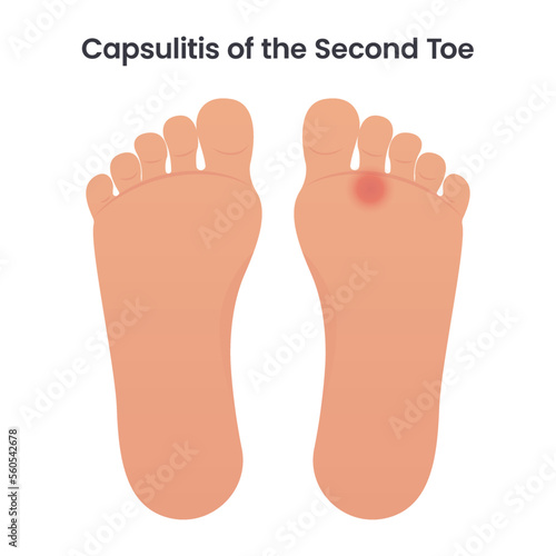 Capsulitis of the Second Toe medical vector illustration graphic