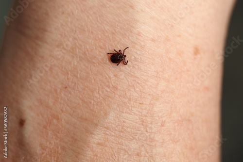 mite,Ixodid, encephalitic live tick on the human body close-up, macro photography. photo