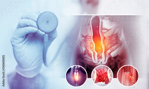 Doctor check and diagnose the Haemorrhoids (piles) on scientific background. Colon cancer. 3d illustration photo