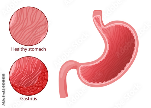 Human healthy stomach and gastritis vector illustration. Cartoon style, white background
