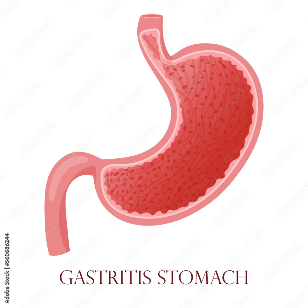 Gastritis mucosa inflammation. Vector illustration, cartoon style ...