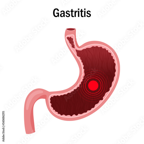 Stomach pain. Pain or disease focus in stomach illustration. Vector illustration, cartoon style, white background. 