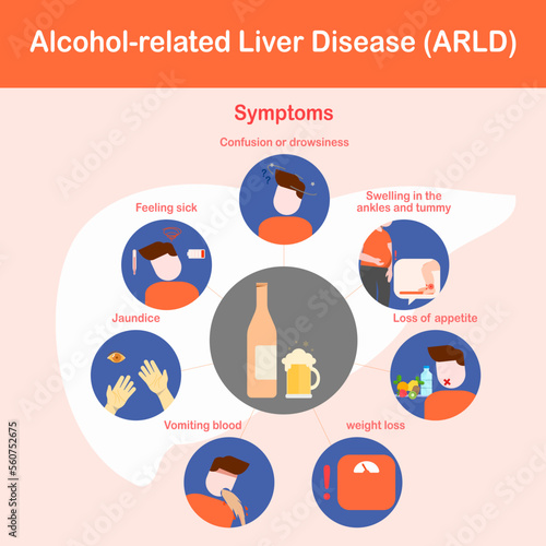 vector illustration , infographic of Alcohol - related liver disease or ARLD symptoms , flat design photo
