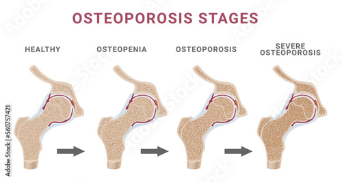 Stages osteoporosis bone spongy structure normal osteopenia severe osteoporosis scheme vector flat