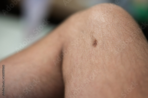 Dark brow birthmark or naevus on male leg.