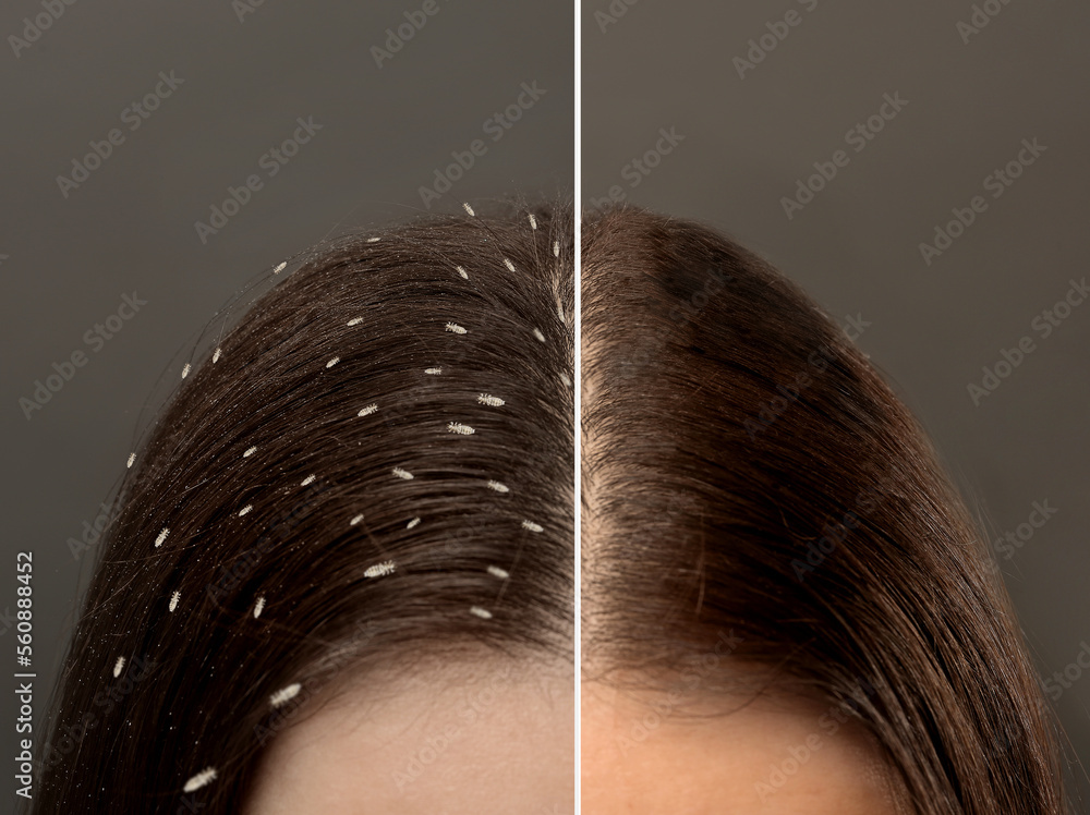 Fotografia do Stock Collage showing woman's hair before and after lice