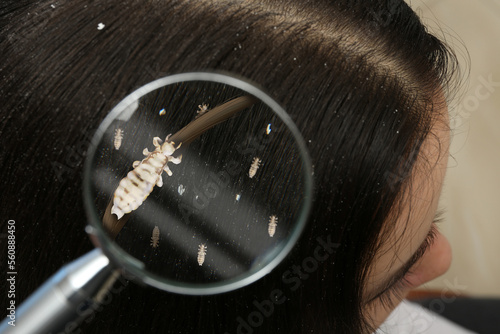 Pediculosis. Woman with lice and nits, closeup. View through magnifying glass on hair photo