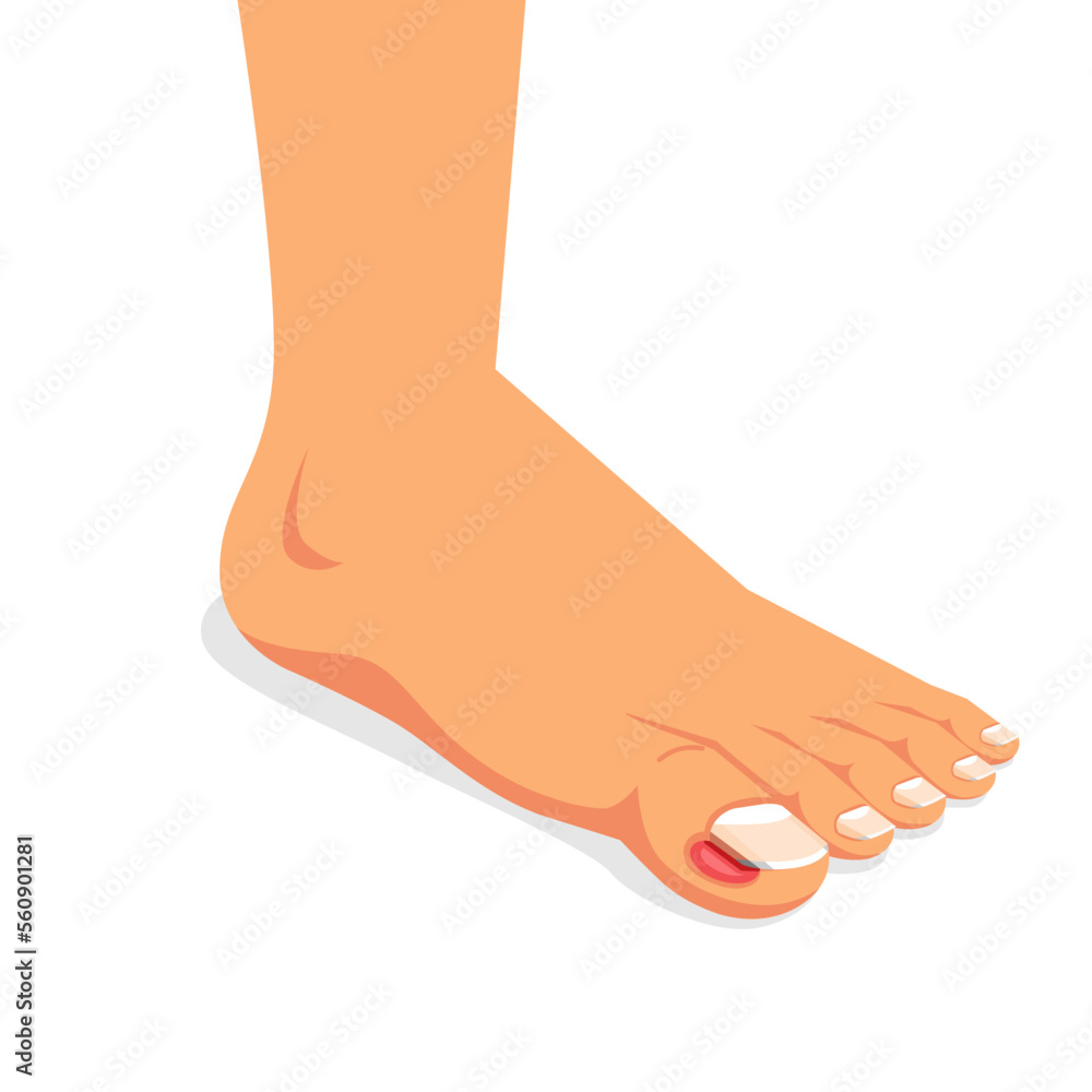 ingrown nail. onychocryptosis. nail disease, flat vector illustration ingrown nail. onychocryptosis. nail disease, flat vector illustration