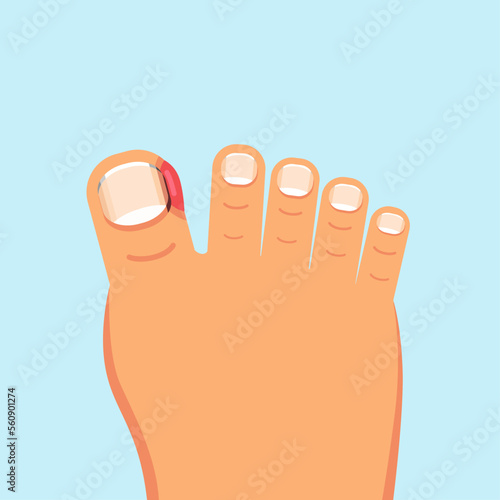 ingrown nail. onychocryptosis. nail disease, flat vector illustration