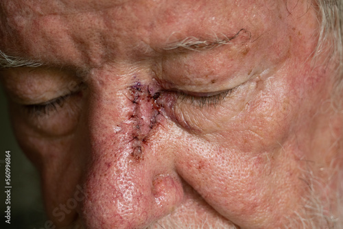 Surgery wound for excision of a BCC skin cancer with skin graft on the nose of a senior male with sun damaged skin. photo