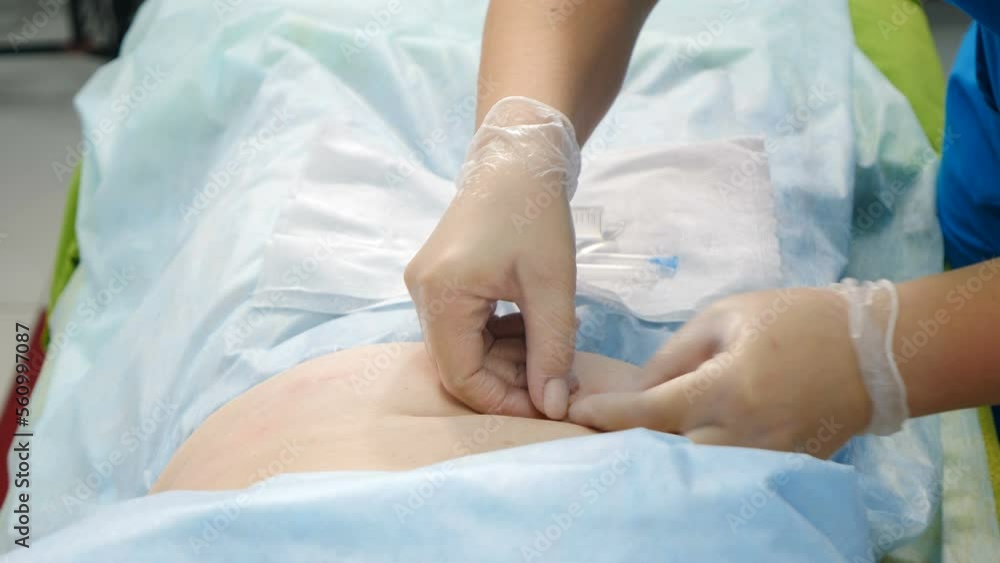 Cosmetologist makes lipolytic injections into female stomach and waist. Dermatologist performing invasive fat reduction procedure in beauty centre. aesthetic cosmetology. 4 k video Cosmetologist makes lipolytic injections into female stomach and waist. Dermatologist performing invasive fat reduction procedure in beauty centre. aesthetic cosmetology. 4 k video