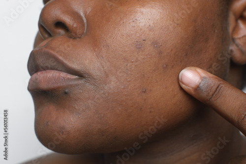 Brown skin with dark spots, hyperpigmentation on brown skin, african american woman with skin blemishes, imperfect skin