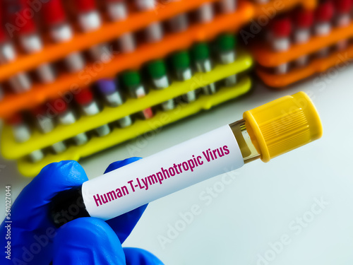 Blood sample for Human T-lymphotropic virus or Human T-cell leukaemia virus or HLTV test, to diagnose a type of cancer called adult T-cell leukaemia or Lymphoma. photo