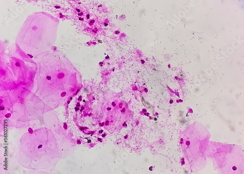 Photomicrograph of gram stain showing Bacterial Vaginosis photo