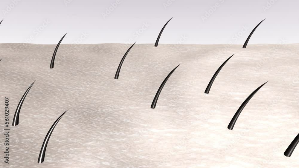 Laser hair removal. Destruction of follicles and hair loss after a few ...