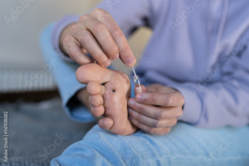 Alternative home treatment of verruca foot. Man applying liquid celandine extract on the wart plantar of his foot. Human papilloma callus virus or HPV, viral skin infection concept.  © DimaBerlin