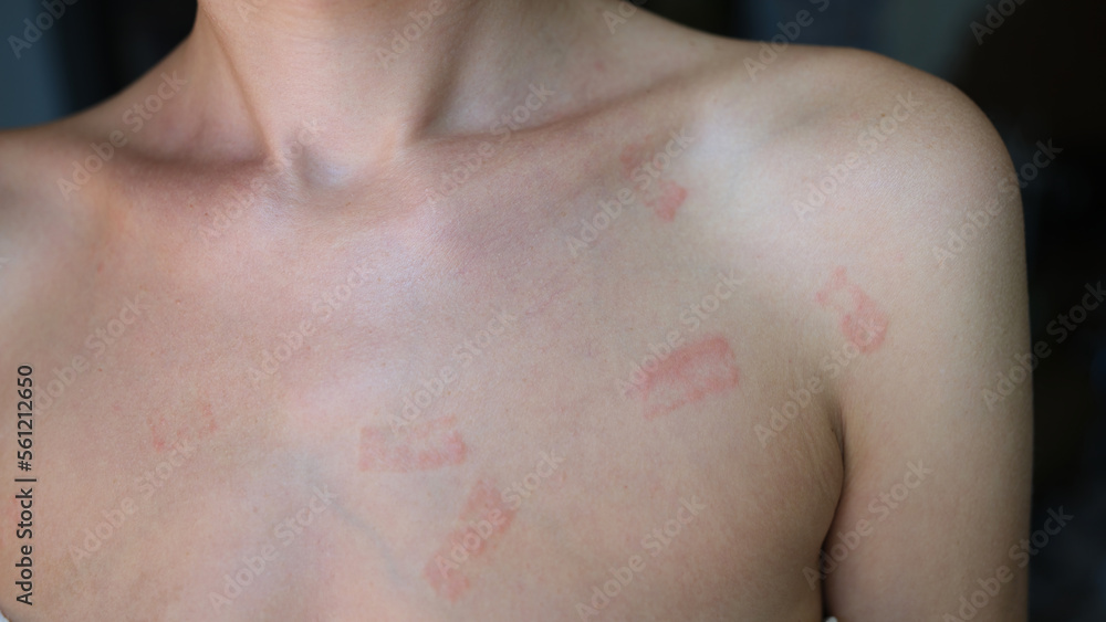 Naklejka premium Red allergic spots rash on female body closeup