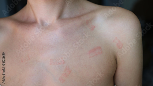 Red allergic spots rash on female body closeup