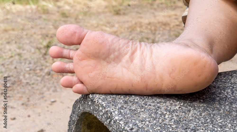 Woman suffering from foot sore caused by Athlete's foot, Patient