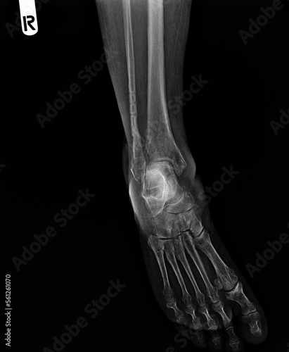 film x-ray of human's foot ( side view ) ( lateral )