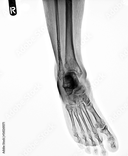 film x-ray of human's foot ( side view ) ( lateral ) photo