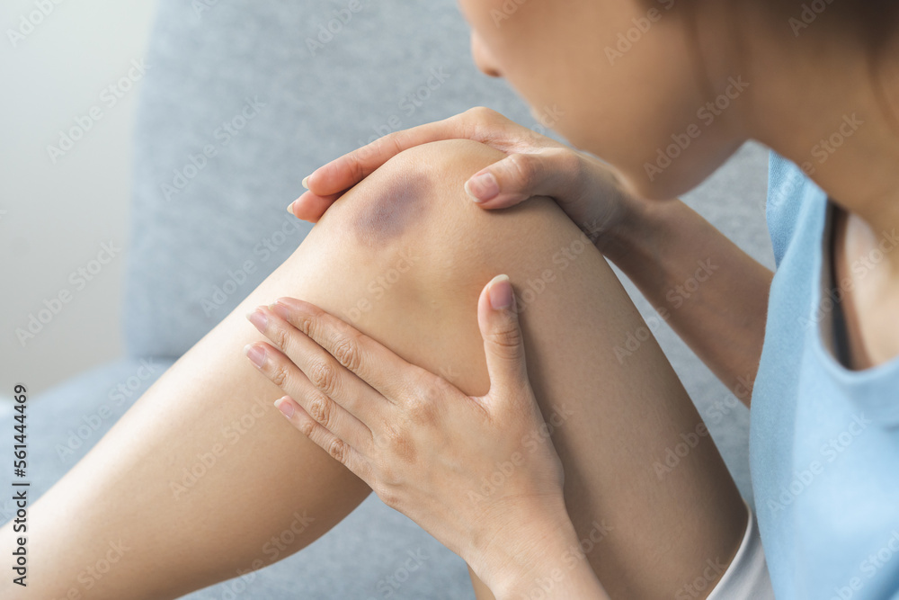 Φωτογραφία Close up of stain bruise wound on leg, contusion asian young woman, girl on joint knee from an accident fell down, hand in healing injury by massage hematoma blood
