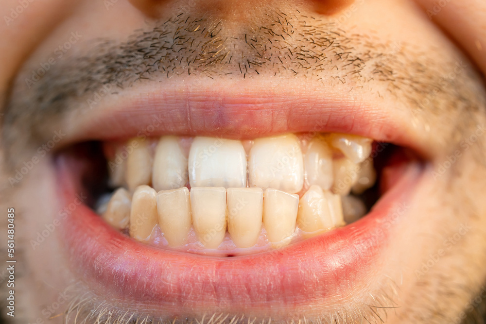 anterior crossbite smile. Curved male teeth, before installing braces