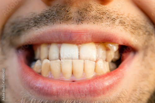 anterior crossbite smile. Curved male teeth, before installing braces. photo