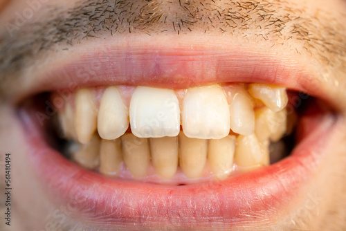 Close up of man's face with crooked teeth before install braces. Teeth need ortodontic treatment. photo