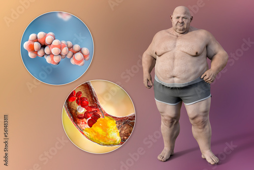 Obesity and atherosclerosis, 3D illustration showing cholesterol molecule, atheromatous plaque inside artery leading to narrowing of blood vessel in obese person photo