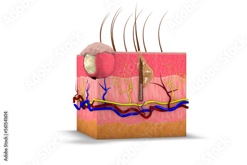 Section of skin with cyst, subcutaneous swelling. Pilar cyst and sebaceous cyst. Skin care, dermatology. 3d rendering photo