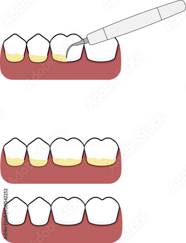 an illustration of dental scaling and cleaning by removing tartar or plaque using ultrasonic scaler