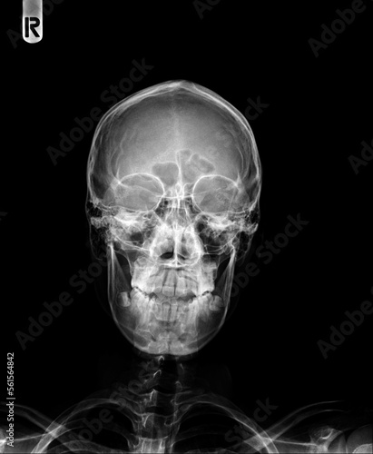Film x- ray skull AP normal 