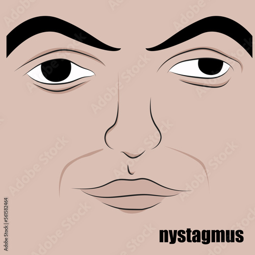 condition in which the eyes move rapidly and uncontrollably. The movement can be: from side to side, up and down.