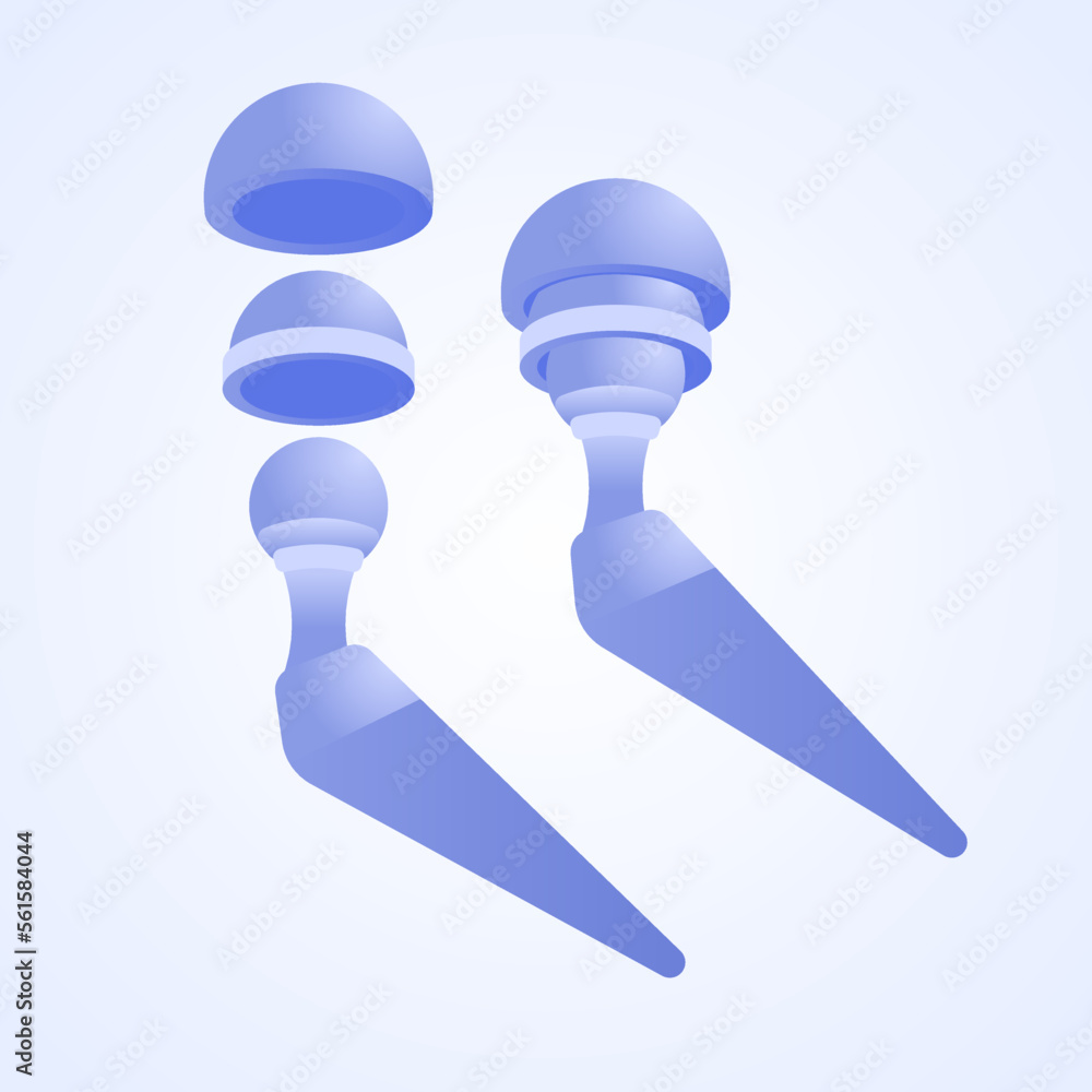 Titanium joint. Total hip replacement or arthroplasty. Structure of the