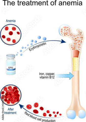 Erythropoietin and treatment of anemia. Vial with EPO.