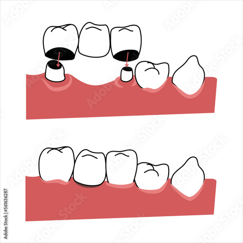 Flat informational graphic of dental bridge installation. Human anatomy scientific illustration for educational or advertising use