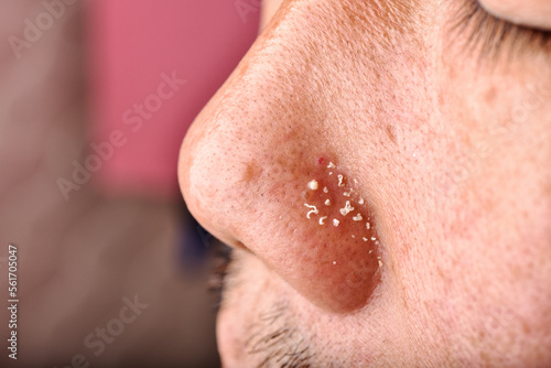 Obraz na płótnie Men skin problem, Acne squeeze, Whitehead comedone pus extraction, Close up man face with clogged pores pimple on nose, Scar and oily greasy face, Beauty concept. w salonie