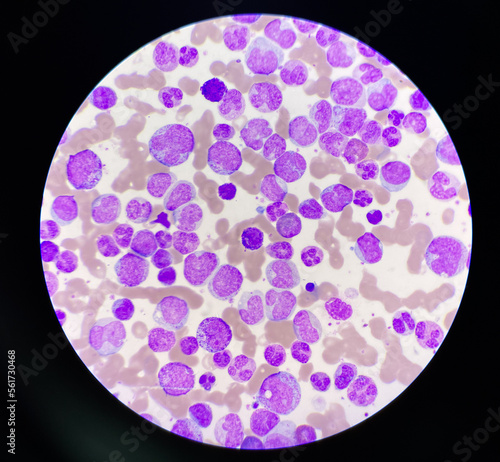 Blood smear leukaemia white blood cells blast.