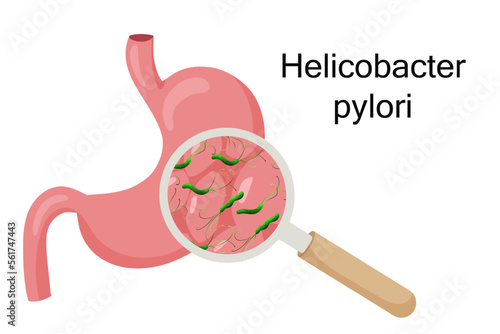 Gastritis with helicobacter pylori under magnifying glass. Vector illustration, cartoon style