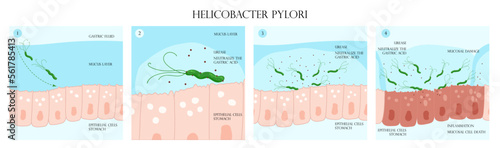 Helicobacter pylori infection process in stomach mucosal layer infographic photo