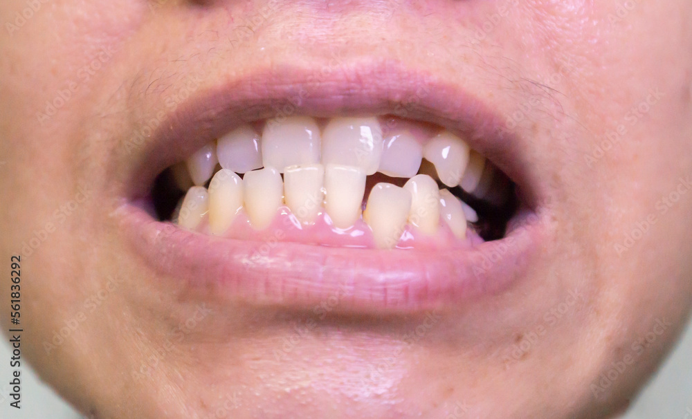 Obraz premium close up of a person distorted teeth