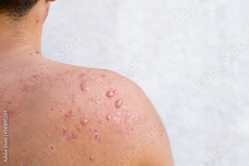 occipital acne in a teenage boy healed, scars from teenage acne on the shoulders, skin infections and allergies to the body of a man, healthcare and medical concept photo