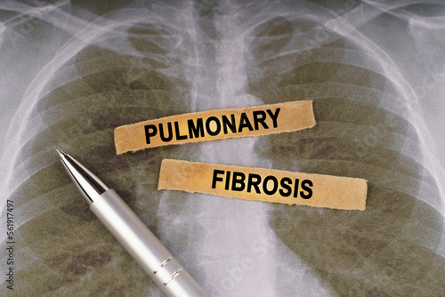 On a human chest x-ray, a pen and strips of paper labeled - pulmonary fibrosis photo