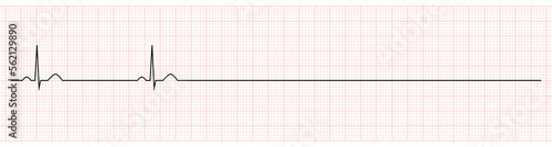 EKG Showing Sinus Bradycardia with Arrest of Patient 