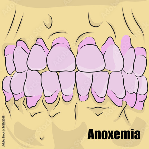 Anoxemia due to hanging, Lack of oxygenation of the blood, change in the color of the teeth.