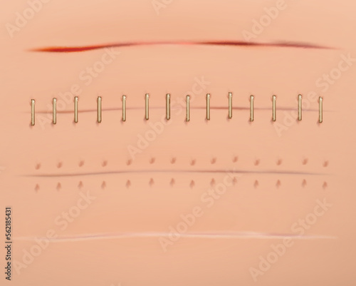 Realistic scars. Medical surgical sutures wounds close up pictures on human skin decent vector illustrations set