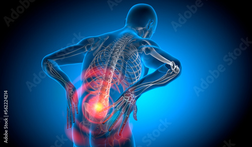 X Ray 3D Rendering - Man with severe pain in the lower spine and intervertebral discs - Herniated disc
