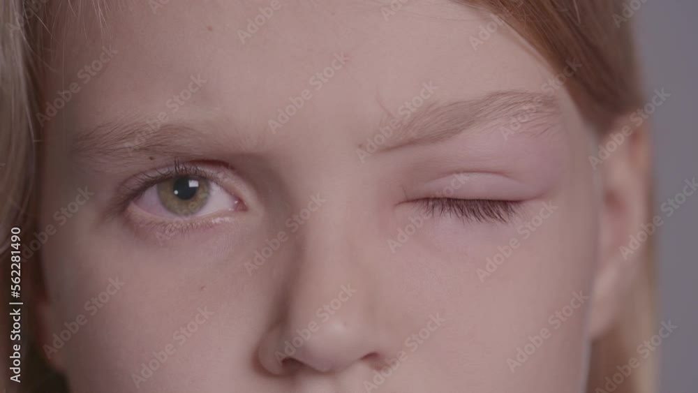 Extreme close-up upset teen girl with a swollen and inflamed eye looks at the camera. A child with a very swollen eyelid, because of the disease eye is closed and cannot open. Extreme close-up upset teen girl with a swollen and inflamed eye looks at the camera. A child with a very swollen eyelid, because of the disease eye is closed and cannot open.